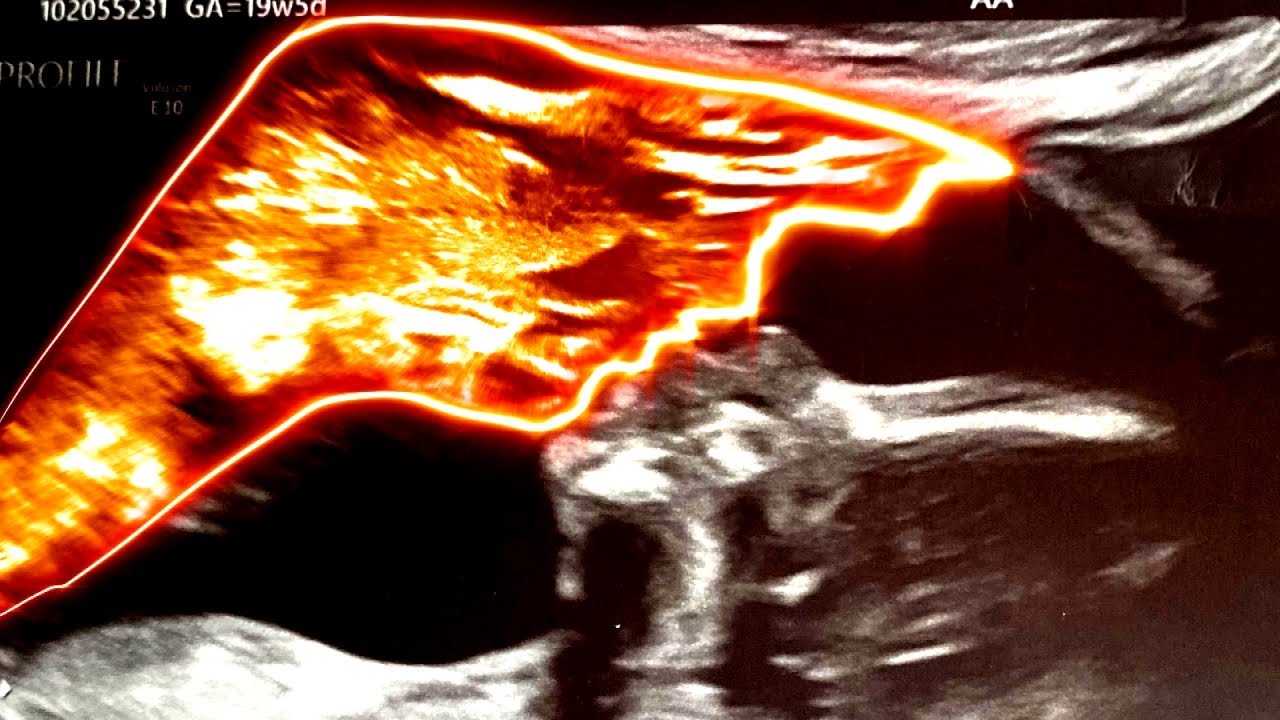 Why Baby's Sonogram Shocked This Mom