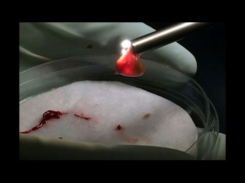 California man survives parasite in brain
