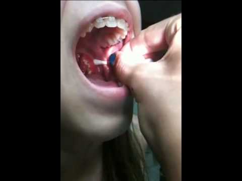 GNARLY TONSIL STONE REMOVAL!!!!