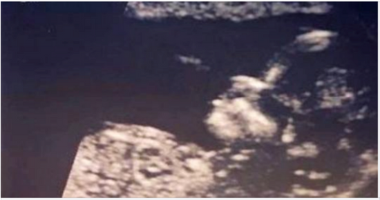 This baby was born with so much hair that it was visible on the x-ray taken of her while she was still in her mother’s womb.