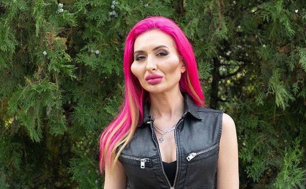 Model with ‘world’s biggest cheeks’ gets face filler to make look even more extreme