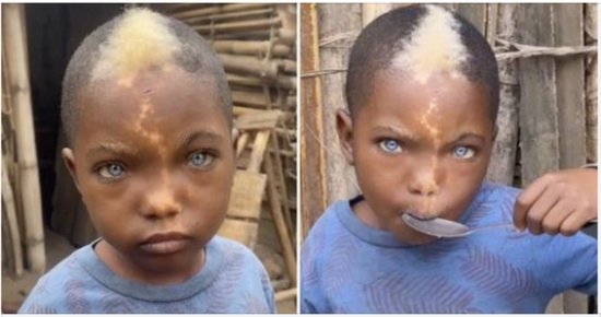Little boy with natural blue eyes, white hairs and lightning mark down his face goes viral