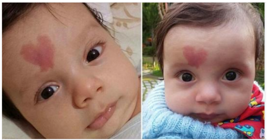 Baby born with ‘heart’ birthmark became world famous in 2015 – here’s what he looks like 4 years later