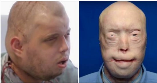 Patrick Hardison received a new face after third-degree burns, this is him today