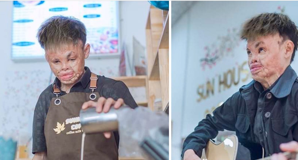 Burn survivor who didn’t leave home for 2 years now owns his own bakery – “I am more than how I look”