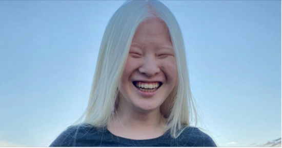Girl abandoned at birth for her looks wants to prove the world wrong – she now models for Vogue