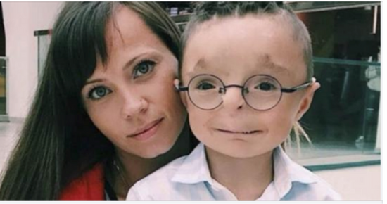 Woman adopts a boy no one wanted to adopt: see what he looks like now