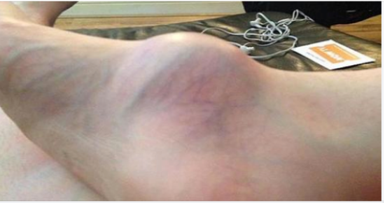 Womans Foot Has Been Swollen For Years, Then She Finally Goes To The Doctor To Find Out Why