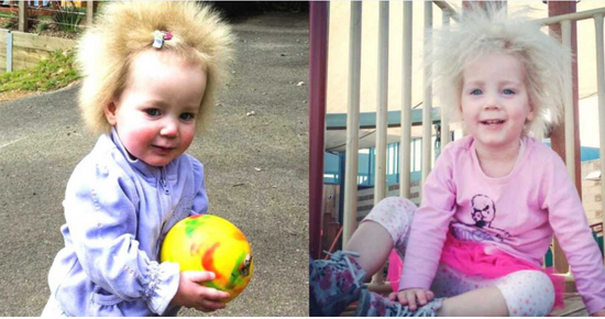 ”Did she stick her finger in the power socket?” Girl with fuzzy hair now embraces her extremely rare condition