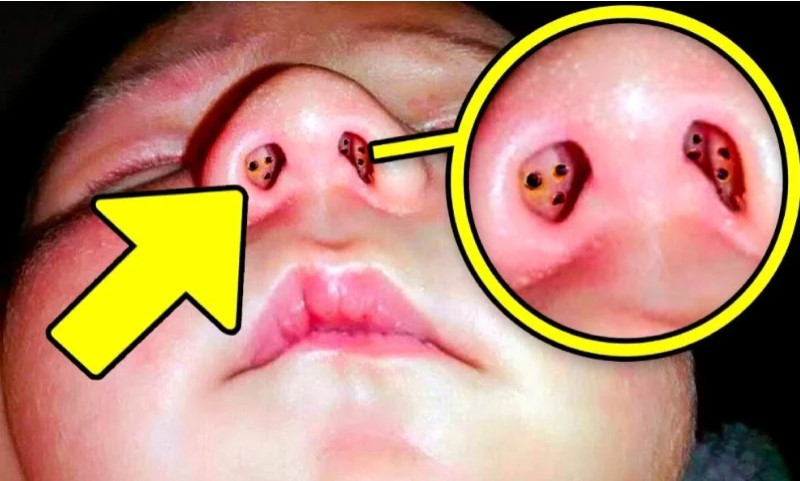 Mother Notices Holes in Baby’s Nose – Then The Doctors Discover Something Troubling