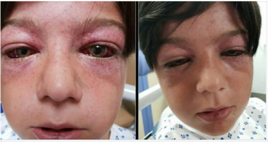 Playground craze leaves 11-year-old boy “looking like an alien” – mom issues warning for parents