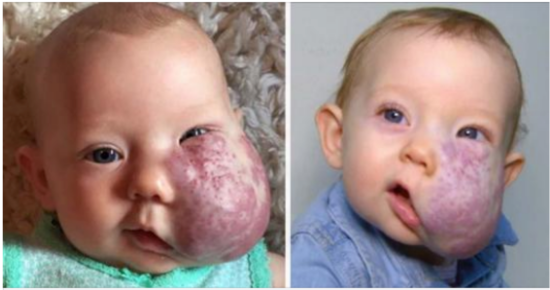 The incredible story of Sloan McGillis: She was born with a giant facial tumor – but overcame all obstacles