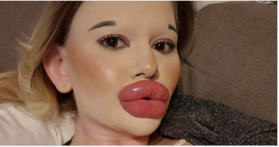 25-Year-Old Bulgarian Woman Does More Than 27 Procedures To Have The Biggest Lips In The World