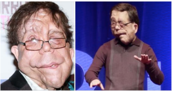 The extraordinary life of Adam Pearson: The actor with a genetic disorder didn’t let anyone stand in his way