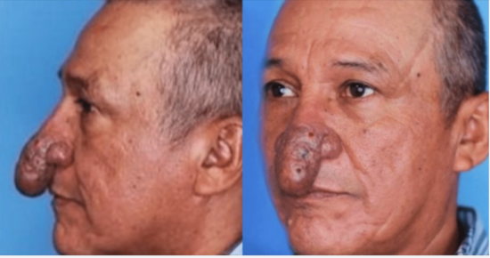 The Remarkable Transformation of Conrado’s Nose