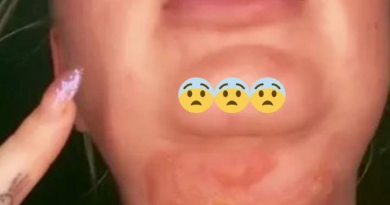 I got second-degree burns from jaw-sculpting surgery to give me a thinner face, I might be scarred for life & can’t talk 