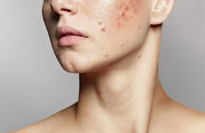 Seven (7) Things That Clog Your Pores And Cause Acne