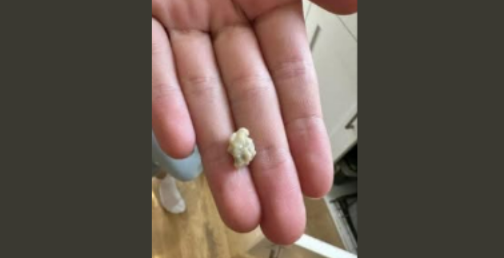 What You Should Know About Tonsil Stones
