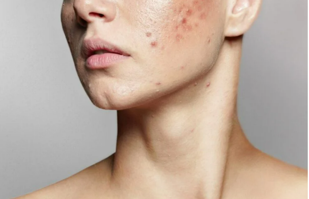 7 Things That Clog Your Pores And Cause Acne