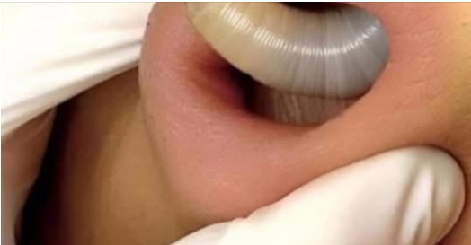 An enormous blackhead in the ear!