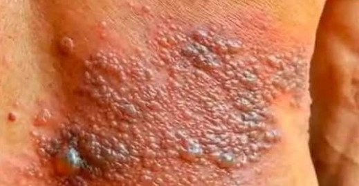 See more It was itching his body, he thought it was an allergy, but a tough diagnosis