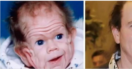 Tomm Tennent: The unique baby born with enough skin to cover the body of a five-year-old child