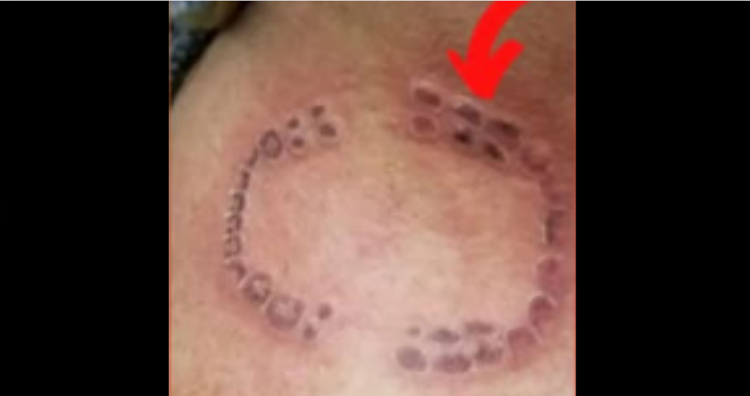 A woman’s strange bite-mark tattoo is being ridiculed for “looking like a disease.
