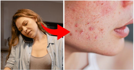 8 Body Parts Acnes Can Appear And What Triggers Them