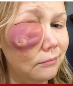 Gina Anderson was left with a big hole in her face after filler failure – this is her today, 6 years later