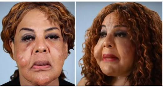 Rajee Narinesingh had her face pumped with cement and superglue– this is her today