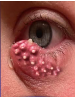 Understanding Eye Infections: Causes, Symptoms, and Effective Treatments