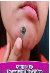 Why Nose Acne Happens So Often — and What Your Skin Is Telling You